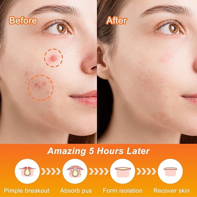 Pimple Patches,Halloween Acne Patch,Pimple Patches for Face, Cute Stickers,Salicylic Acid & Tea Tree, 100PCS Hydrocolloid Dots in 8 Colors for Face,Cute Halloween Stickers