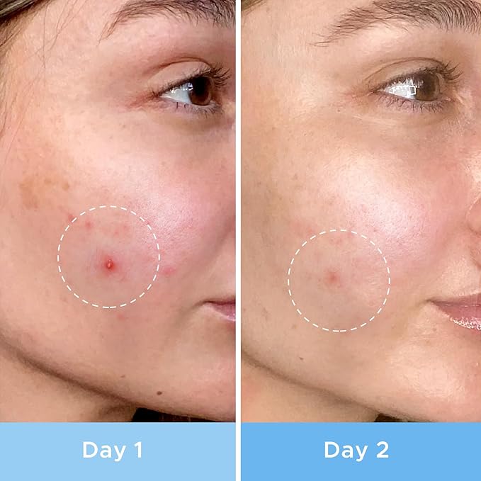 LitBear Pimple Patches, Upgraded Invisible Acne Cover Patch, Hydrocolloid Acne Patches for Face with Salicylic Acid