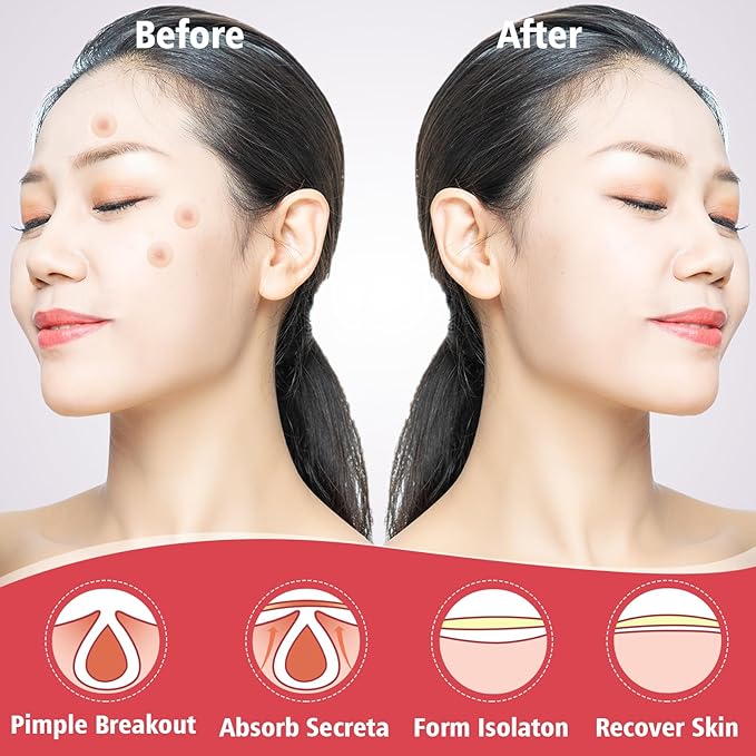 450 Pimple Patches for Face, Hydrocolloid Acne Patches for Zit Covers, Mighty Patch Acne Invisible Zit Patches for Face, 4 Sizes
