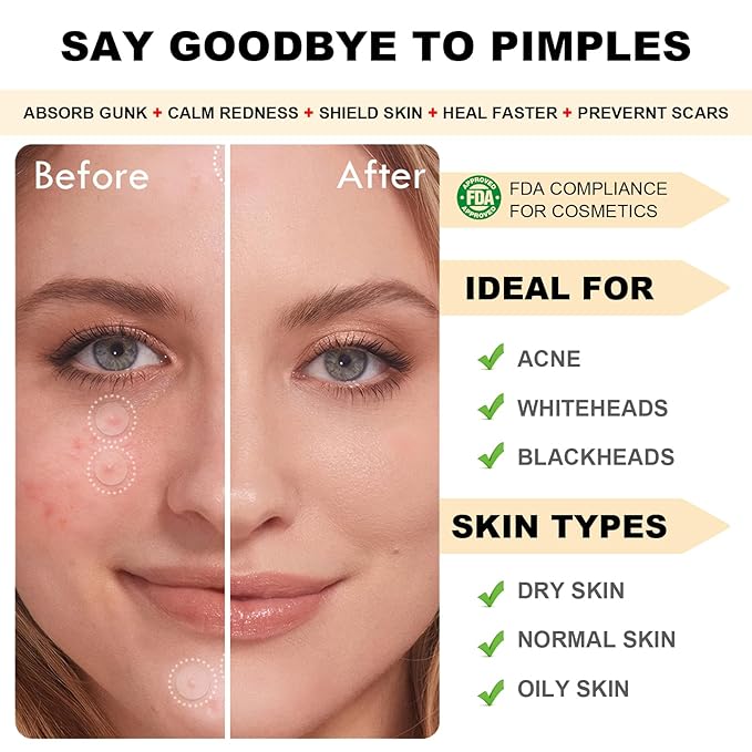 Pimple Patches for Face,Pimple Patch Pimple Stickers - Hydrocolloid Acne Patch for Covering Zits and Blemishes,Invisible Spot Rescue Pen-Quickly Covering and Shrinking Acne