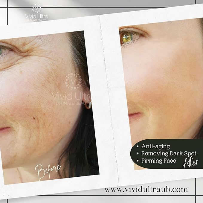 Vivid Ultra Vitamin C Serum for Face – Anti-Aging Serum with Hyaluronic Acid, Collagen & Vitamin E – Brightening Dark Spots, Firming Skin, Reducing Wrinkles & Acne Scars – 1 Fl Oz