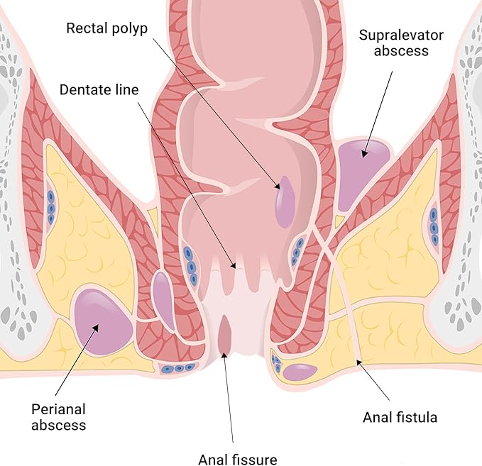 LMNOOP® Perianal Care Cream, Fast Healing Wounds for Anus Fissure, Abscess, Ulcer, Infection, Postpartum & Anal Fistula Surgery Wounds Recovery Ointment, Wound Treatment Cream for Itch Burning Relief