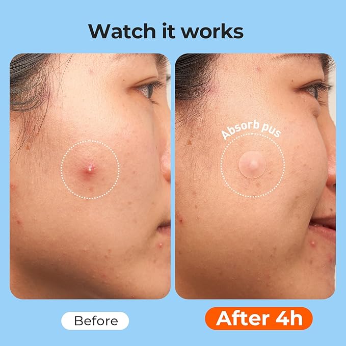 TKTK 609 Count Pimple Patches for Face, Hydrocolloid Acne Patch Bulk, Acne Stickers for Covering Cheeks, Forehead, Chin Blemishes Zit Breakouts for All Skin Types (Dots, Strip, Contoured 5 Sizes)