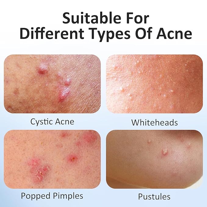 Star Pimple Patches for Face, Acne Patches, Cute Colorful Star Zit Covers with Hydrocolloid & Tea Tree Oil, Salicylic Acid Cica Extract 4 Sizes (8mm/9mm/11mm/14mm) | 612 Count