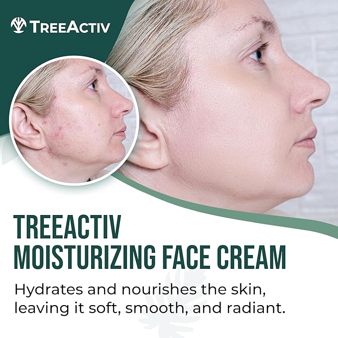 TreeActiv Acne Cream Original Formula, 2 fl oz, 2% Salicylic Acid Face Moisturizer for Oily Skin, Skin Care Acne Formula for Cystic Acne Treatment, Hydrating Face Moisturizer for Acne Prone Skin