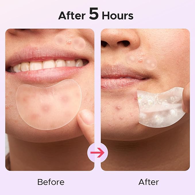 LitBear Large Pimple Patches, 5 Size 416 Count Big Acne Patches for Face, Chin, Forehead and Body, Zit Patches for Dots, Blemishes and Large Breakouts, Hydrocolloid Patch (XL Strip, Contoured, Round)