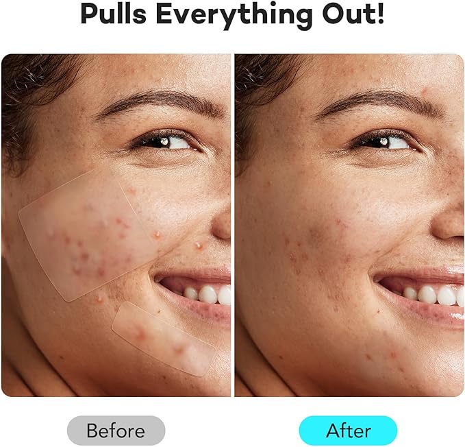 LitBear Large Pimple Patches for Face (6 Sizes 118 Patches), Big Hydrocolloid Acne Patches, XL Hydrocolloid Bandages for Body, Cheek, Forehead, Chin, Full Face, Back, Nose