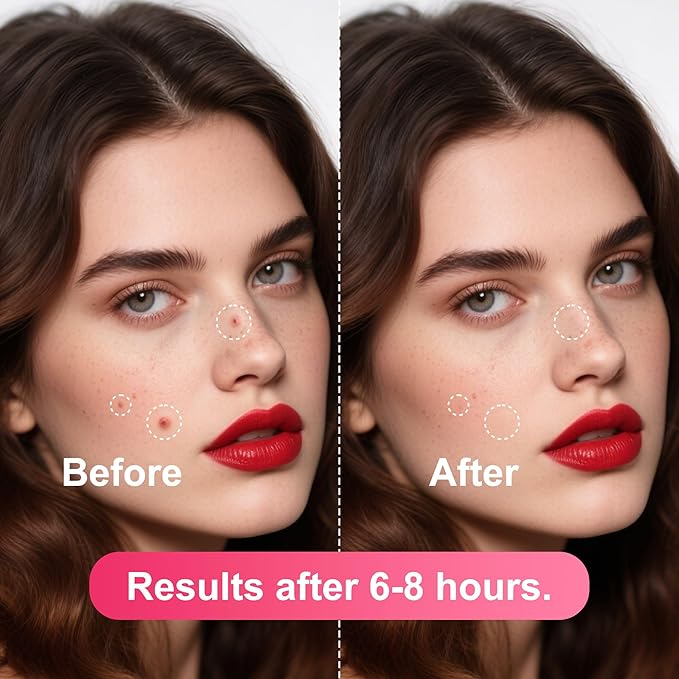 Pimple Patches,Acne Patches,Pimple Patches for Face,Acne Absorbing Cover Patchs,Black Star & Wing Shaped,Salicylic Acid & Tea Tree Oil,Hydrocolloid Pimple Patches(95 Count)