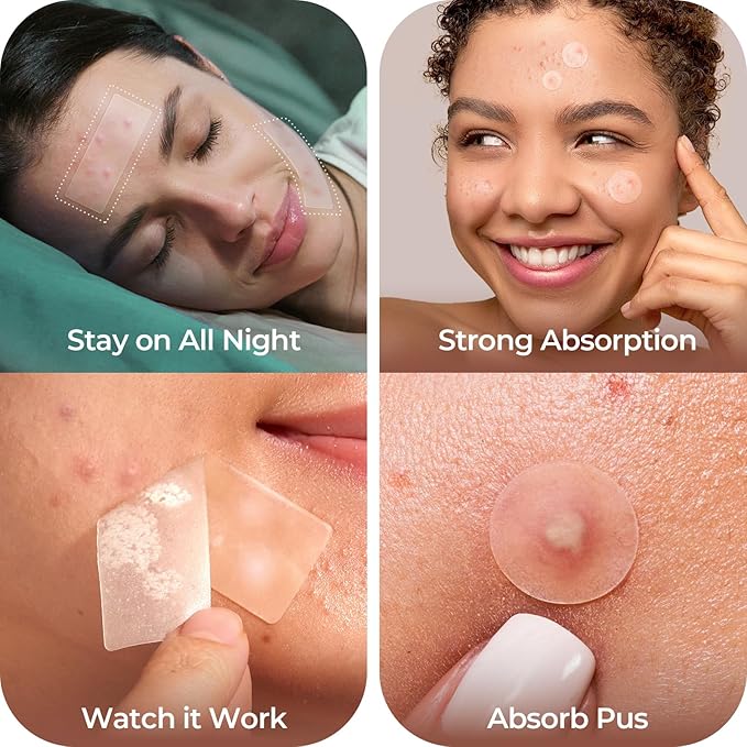 LitBear Large Pimple Patches, (5 Sizes 404 Counts) Big Acne Patches, Big Hydrocolloid Bandages for Body, Back, Face, and Chest, Zit Patches for Large Breakouts, Hydrocolloid Patch (XL Strip, Square)