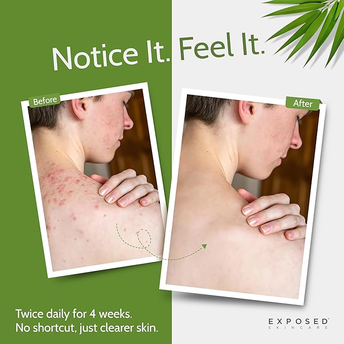 Exposed Skin Care Body Acne Kit – Dual Acne Treatment Serums + Body Wash and Exfoliating Body Cloth – Powerful System Eliminates Pimples and Breakouts to Quickly Clear Back and Body Acne