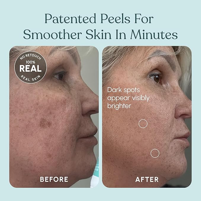 30 DAY MIRACLE AHA 30% + BHA 2% Peeling Solution - Clinical Strength Liquid Exfoliant for Dark Spots, Blackheads & Clogged Pores - Resurfacing Salicylic Acid Serum & Chemical Peel for Face