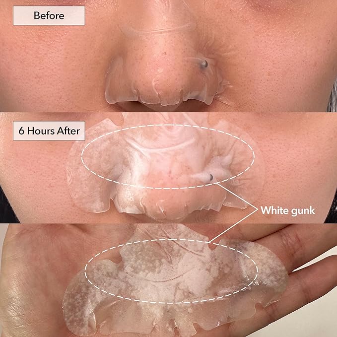 FreeGo Hydrocolloid Acne Patches for Face, Large Pimple Patches for Breakouts, Zit, Blemish Spot, Facial Stickers, Korean Pimple Patches