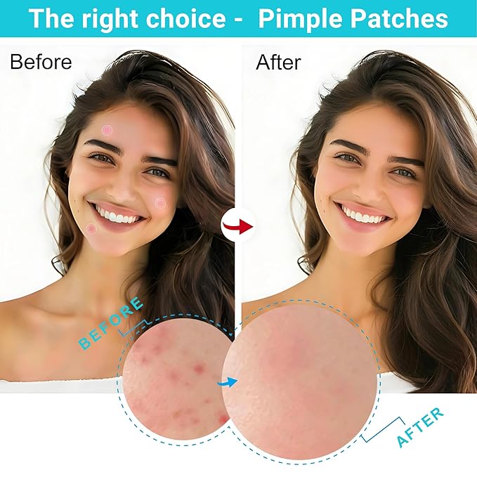 Acne Patch –Invisible Pimple Patches for Face & Body, Miracle Patch with Fast-Acting Hydrocolloid, Salicylic Acid & Tea Tree Oil – Waterproof & Hypoallergenic, 3 Sizes