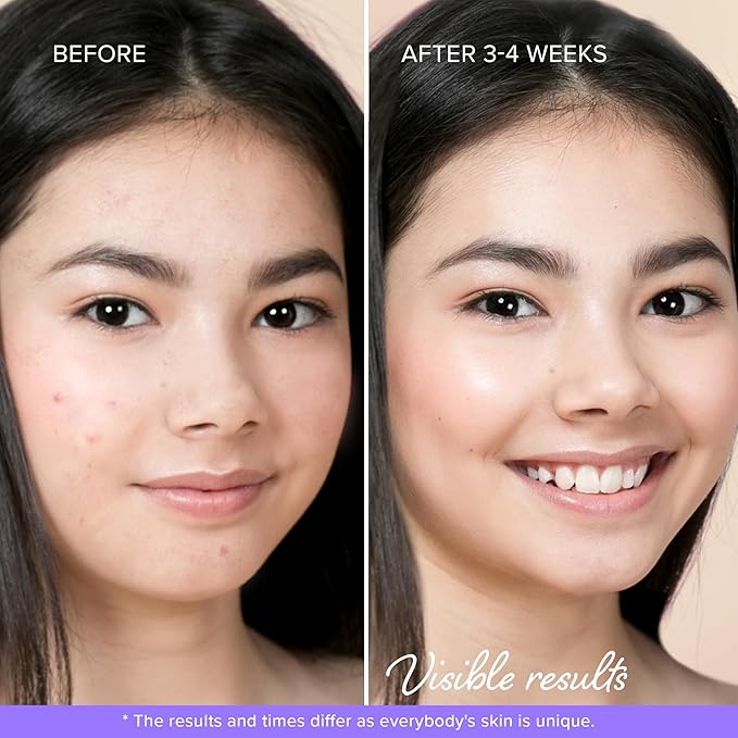 MAREE Star Pimple Patches for Face 2 PACK - Acne Patches - Natural Green Algae Extract & Tea Tree Oil - Hydrocolloid Stars Cute Zit Stickers, Parches Para Acne - Marine Collagen Blemish Pimple