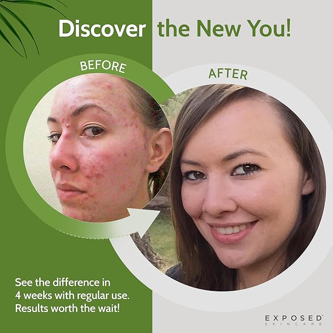 Exposed Skin Care Acne Facial Cleanser – Gentle Salicylic Acid Face Wash for Acne-Prone Skin – Pore Clarifying Wash for Teens & Adults, All Skin Type