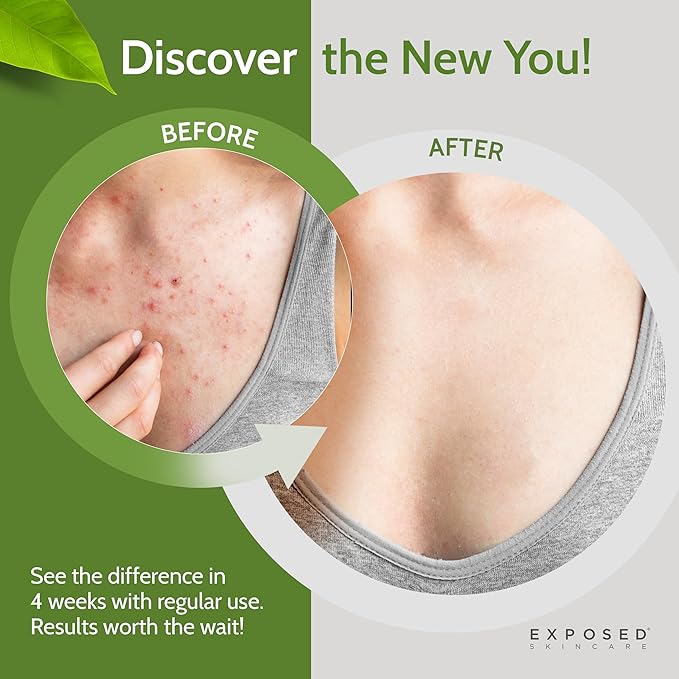 Exposed Skin Care Body Acne Kit – Dual Acne Treatment Serums + Body Wash and Exfoliating Body Cloth – Powerful System Eliminates Pimples and Breakouts to Quickly Clear Back and Body Acne