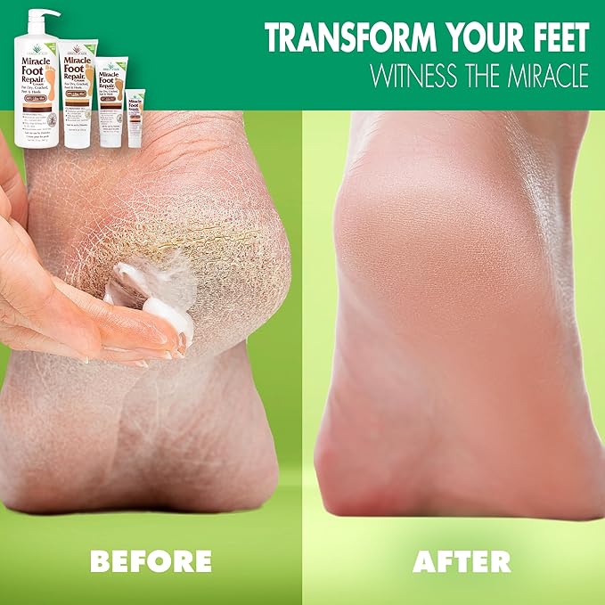 Miracle Foot Repair Cream, 4 oz Repairs Dry Cracked Heels and Feet, Diabetic-Safe, 60% Pure Ultra Aloe Moisturizes, Softens, and Repairs, Relief from Discomfort of Ingrown Toenails (2-Pack)