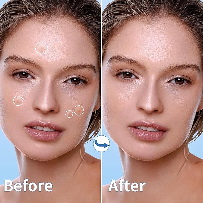 Pimple Patches for Face, 3 Size 510 Counts Hydrocolloid Acne Patches for Covering Zits and Blemishes, Spot Stickers with Salicylic Acid, Tea Tree Oil & Calendula Oil(8mm,10mm,12mm)