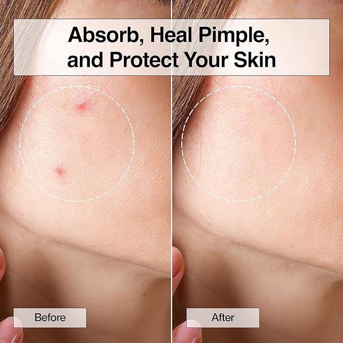 FreeGo XOXO Hydrocolloid Pimple Patch, 120 Counts | Cute Colorful Heart Shape | Salicylic Acid, Niacinamide, CICA, Tea Tree, Eucalyptus | Absorb, Heal Pimple and Protect Skin