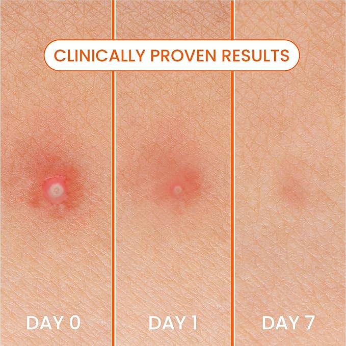 Biore Pimple Patches, Cover & Conquer Blemish Patch, Medical Grade Ultra-Thin Hydrocolloid for Covering Zits and Blemishes, HSA/FSA Approved, 30 Count