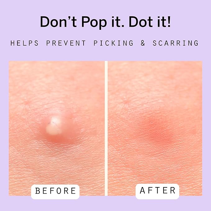 Dot Pimple Zit Patches for Face – Dermatologist Recommended & Ranked 1 for Most Effective Blemish Support – All Natural Hydrocolloid Acne Stickers with Vitamin C & Salicylic Acid (10 mm, 40 ct)