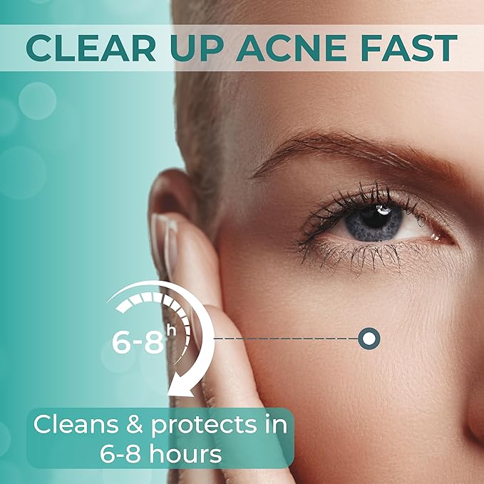 – 144 Count Hydrocolloid Acne Patches with Salicylic Acid, Tea Tree Oil & Centella – Clear Pimple Patch for Overnight Zit & Blemish Spot Treatment for Teens & Adults