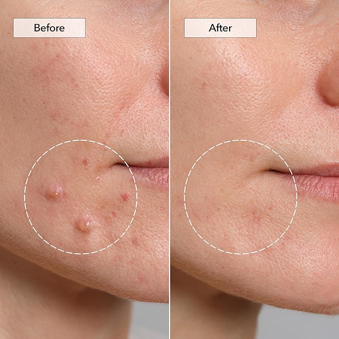 FreeGo Hydrocolloid Acne Patches for Face, Large Pimple Patches for Breakouts, Zit, Blemish Spot, Facial Stickers, Korean Pimple Patches