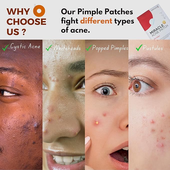 Acne Patch –Invisible Pimple Patches for Face & Body, Miracle Patch with Fast-Acting Hydrocolloid, Salicylic Acid & Tea Tree Oil – Waterproof & Hypoallergenic, 3 Sizes