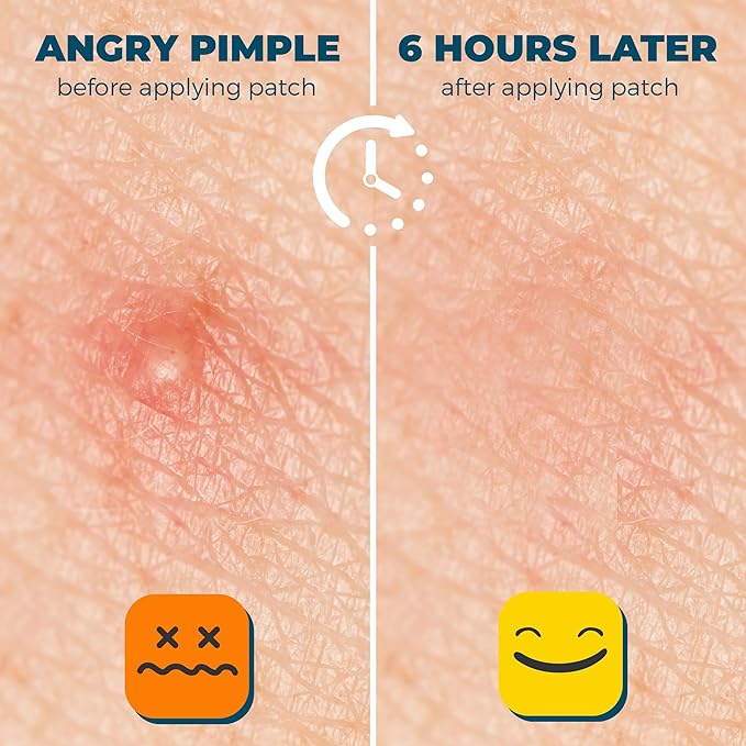 Acne Pimple Patches For Face - Clear Hydrocolloid Acne Patch Zit Stickers - Pimple Patches Salicylic Acid & Tea Tree Oil - Invisible Dots Spots For Sensitive Skin Blemish & Pimples Parches (300 Pack)