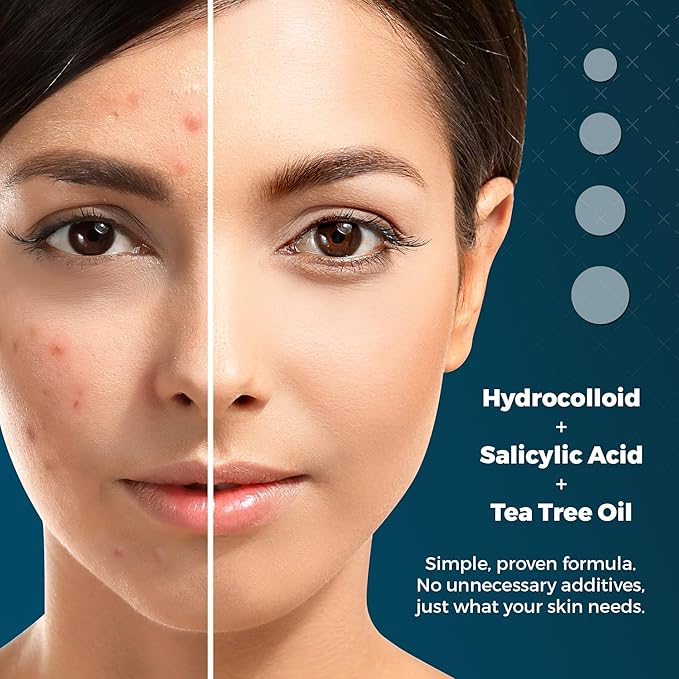 Acne Pimple Patches For Face - Clear Hydrocolloid Acne Patch Zit Stickers - Pimple Patches Salicylic Acid & Tea Tree Oil - Invisible Dots Spots For Sensitive Skin Blemish & Pimples Parches (300 Pack)