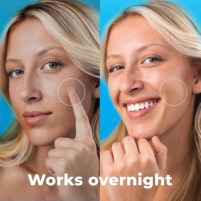 Pimple Patches for Face (240 Patches), Hydrocolloid Acne Patches with Tea Tree Oil, Pimple Stickers - Acne Pimple Patches For Face - Zit Patches