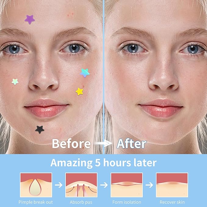 Pimple Patches for Face, 3 Size 280 Counts Hydrocolloid Acne Patches, Cute Star Pimple Stickers with Salicylic Acid, Tea Tree Oil & Calendula Oil, for Covering Zits and Blemishes