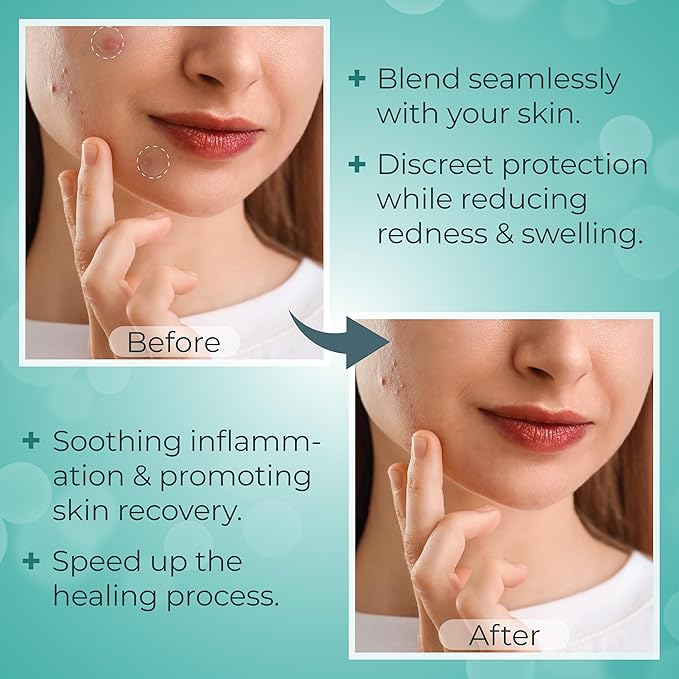 – 144 Count Hydrocolloid Acne Patches with Salicylic Acid, Tea Tree Oil & Centella – Clear Pimple Patch for Overnight Zit & Blemish Spot Treatment for Teens & Adults