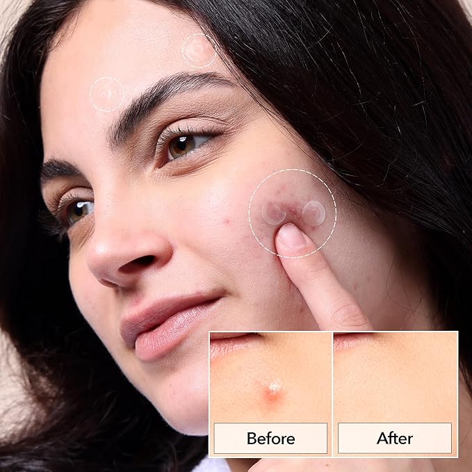 FreeGo Hydrocolloid Acne Patches for Face, Large Pimple Patches for Breakouts, Zit, Blemish Spot, Facial Stickers, Korean Pimple Patches