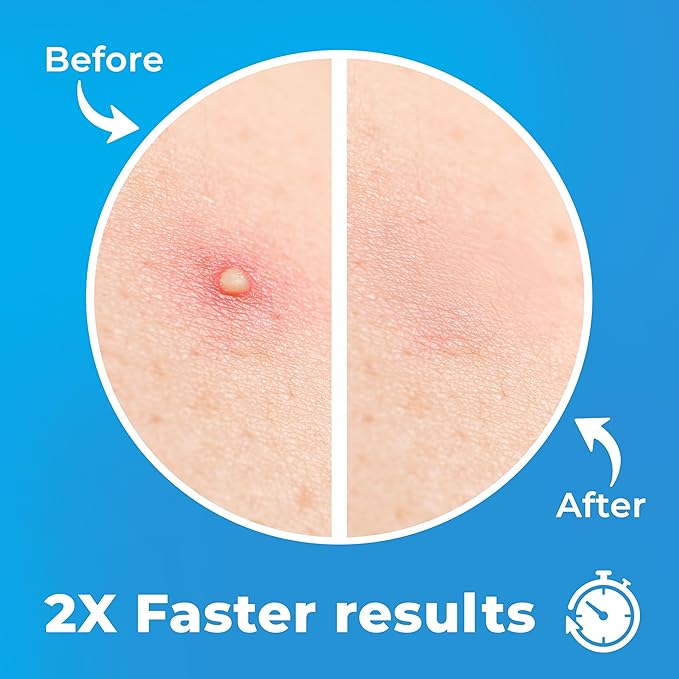 Pimple Patches for Face (240 Patches), Hydrocolloid Acne Patches with Tea Tree Oil, Pimple Stickers - Acne Pimple Patches For Face - Zit Patches