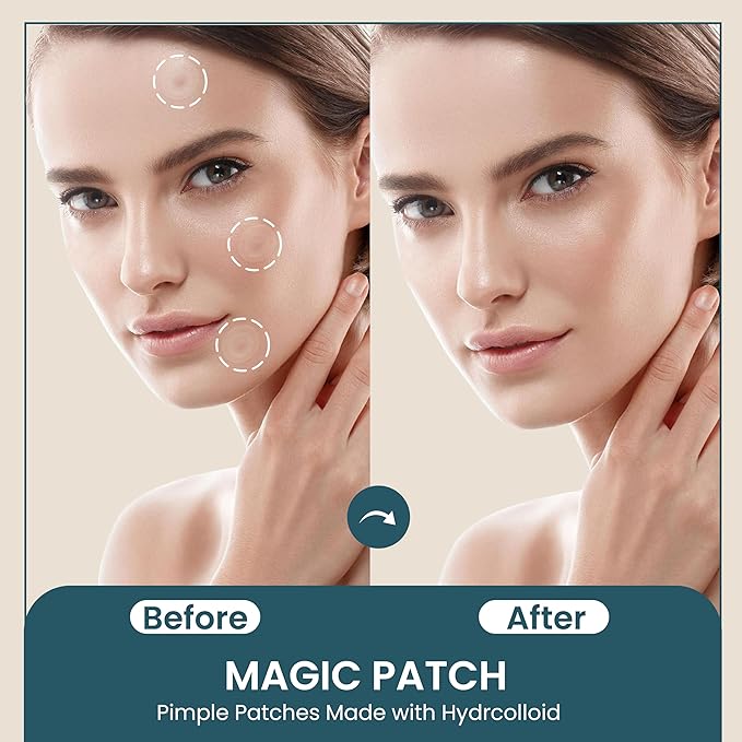 MAGIC PATCH - Pimple Patches - Invisible Fast-Acting Acne Spot Care for Face & Body - Skin Care Patch for Treating Pimples, Blackheads & Zits - Vegan Hydrocolloid - 60 Pore Patches - By SPLURJ