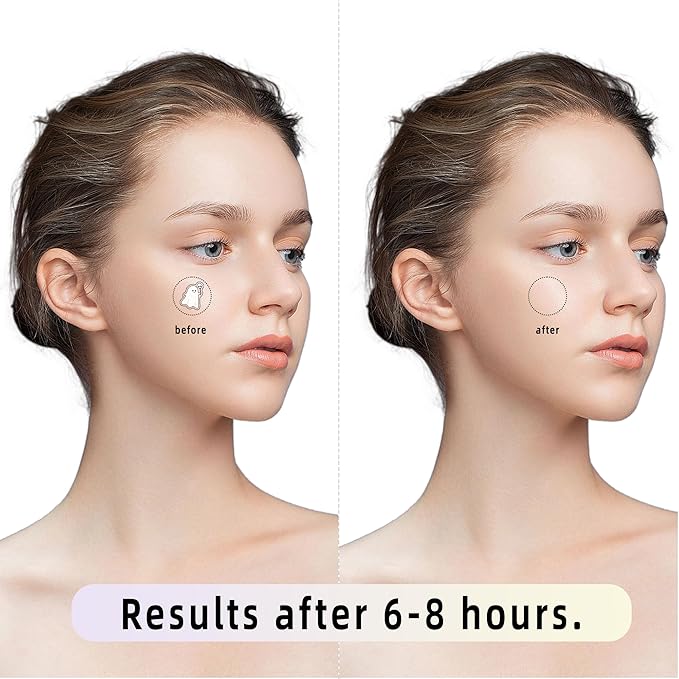 Pimple Patches, Halloween Acne Patch for Zits and Blemishes,Hydrocolloid Acne Pimple Patches for Covering Zits and Blemishes(90 patches)