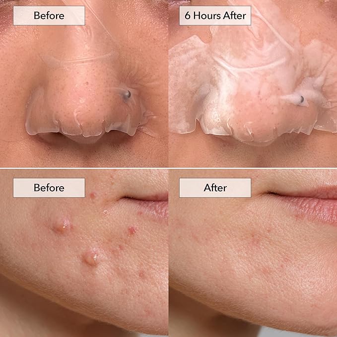 FreeGo Hydrocolloid Acne Patches for Face, Large Pimple Patches for Breakouts, Zit, Blemish Spot, Facial Stickers, Korean Pimple Patches