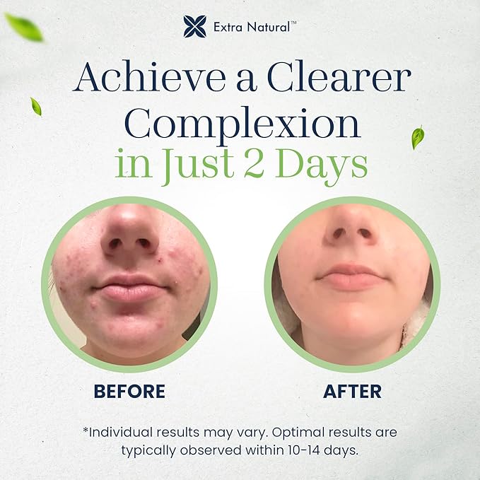 Extra Natural Acne Fade Treatment - Maximum Strength Face Cream for Sensitive Skin - For Pimple, Blackhead, Whitehead, Cystic, Hormonal Acne, Scar - Fast Acting Herbal Formula with Lavender & Tea Tree