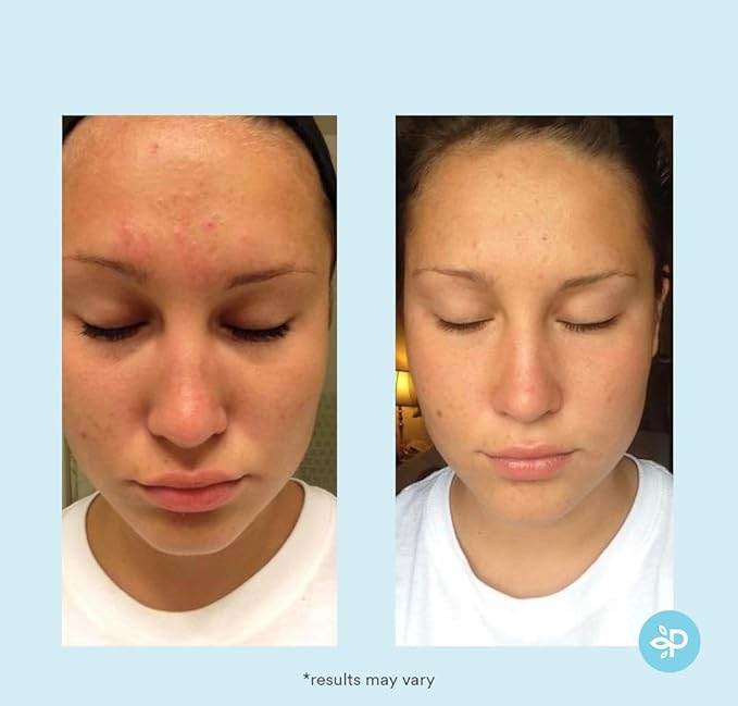 Glycolic Acid 30% Gel Peel - Enhanced with Retinol and Green Tea Extract (Professional Chemical Peel)- 1 fl oz 30mL