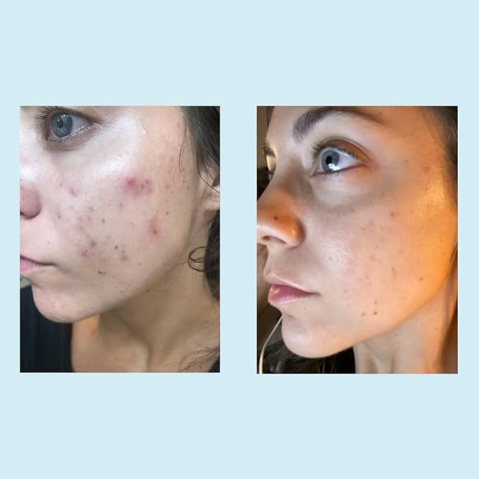 Glycolic Acid 30% Gel Peel - Enhanced with Retinol and Green Tea Extract (Professional Chemical Peel)- 1 fl oz 30mL