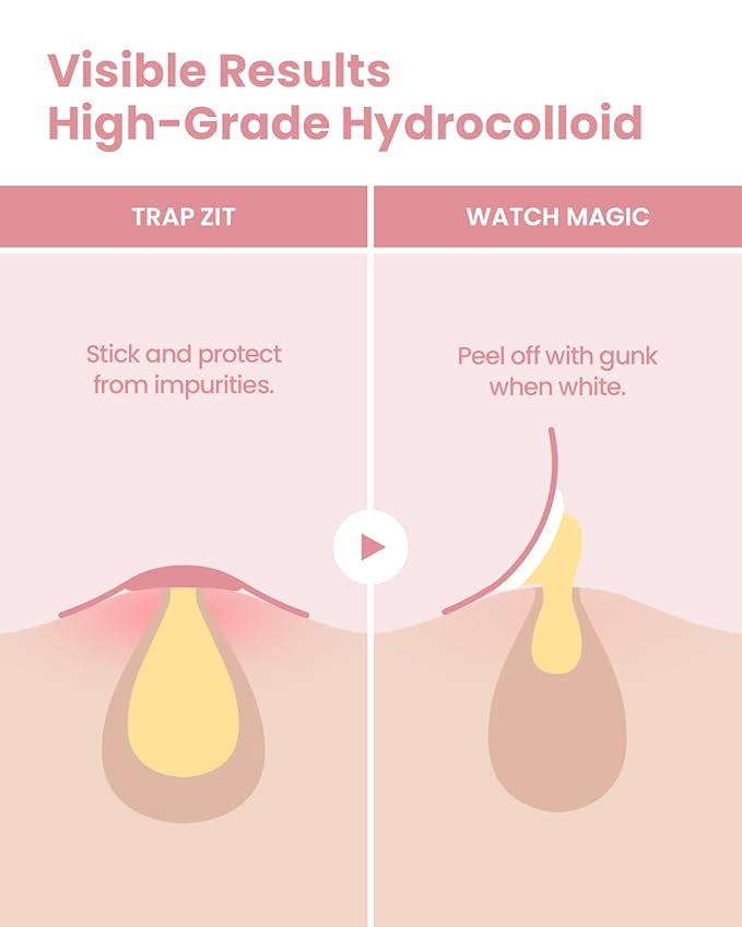 GLAM UP Hydrocolloid Blemish Pimple Zit Patches(180PCS/2Size) - Invisible Ultra Thin Spot Cover Stickers for Face and Skin, Strong Water-proof and Adhesive Overnight, Vegan-friendly