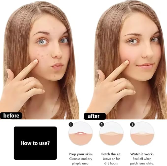 Hydrocolloid Acne Patches, Pimple Spot Treatment, 36 Count