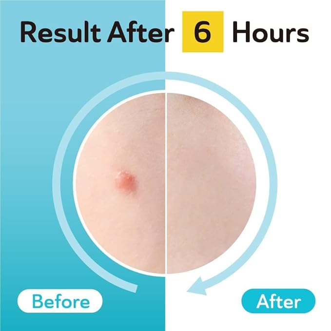 Ultra Invisible Salicylic Acid Acne Patches and Post Acne Dark Spot Patches Bundle - Day and Night Use - UPGRADED