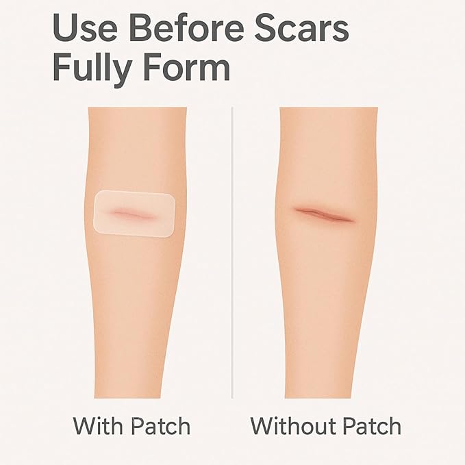 Clear Scar Sheets – 10 Pieces – Skin Patches for Face and Body – Use Before Scars Fully Form – Prevent and Reduce Scars from Acne, Scalds, Burns, Cuts, Abrasions – Thin, Flexible, Waterproof, Gentle