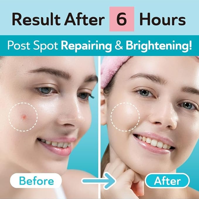 Ultimate Acne Care Bundle – Ultra Invisible Dark Spot Patches for Post Acne, Salicylic Acid Acne Patches for Cystic Acne, Large Pimple Patches for Nose, Chin, Forehead - Day & Night Use – Bundle