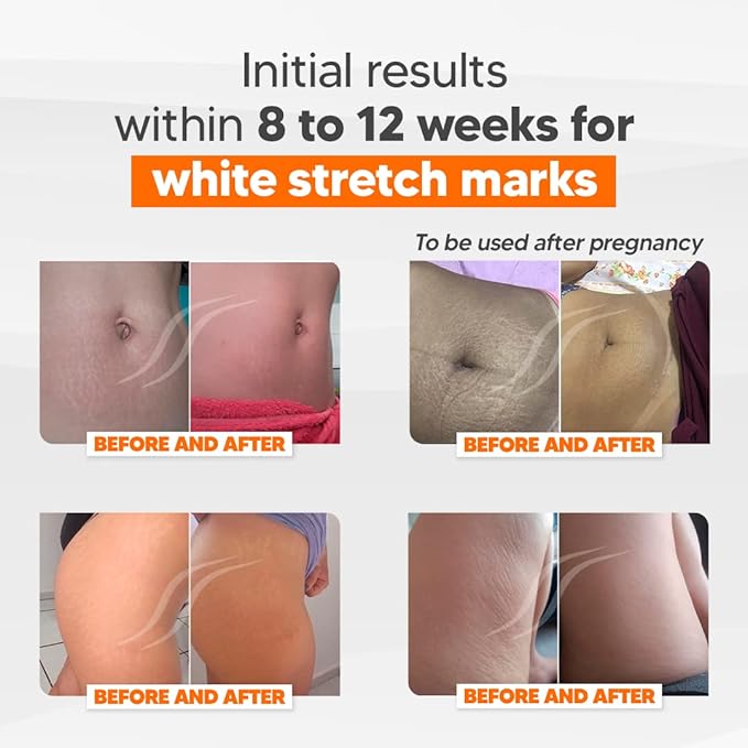 Cicatrissim Deep Stretch Mark Removal Cream