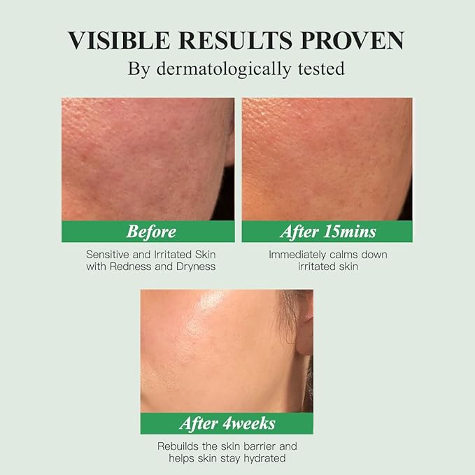 HKH Madagascar Centella Ampoule Serum - Soothing Acne Prone, Sensitive Skin Relief, Calming, Barrier Repair & Intense Hydration, 5X Centella Asiatica (Cica), 5X Ceramides, 8X Hyaluronic Acid, 30ml