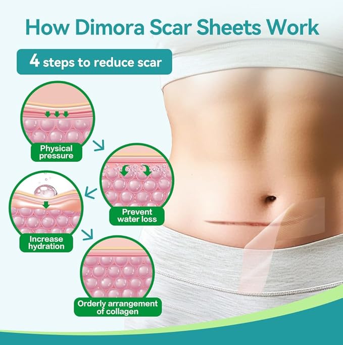 Dimora Medical Grade Silicone Scar Sheets -Ultra Soft Silicone Scar Tape (1.6”x60" Roll), Hypoallergenic Scar Removal Treatment for Surgical Scars, C Section, Tummy Tuck, Keloid Treatment