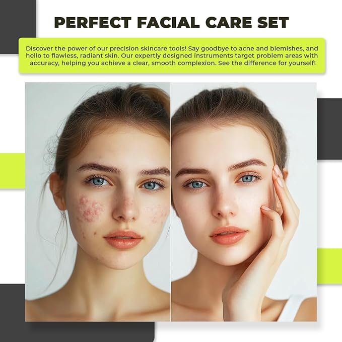 [6 Pcs] Blackhead Remover Tools for Acne - Surgical Stainless Steel Pimple Popper Tool Kit, Comedones & Blemish Extraction Kit